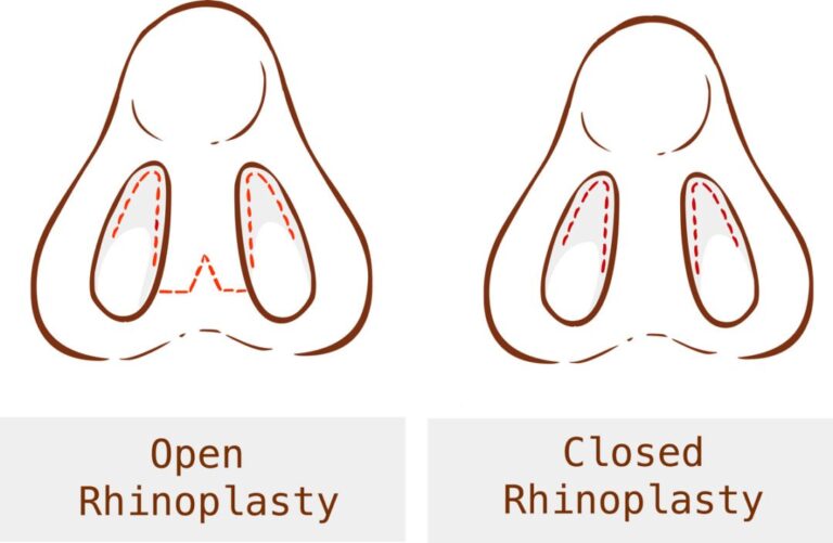 Open vs Closed Rhinoplasty illustration