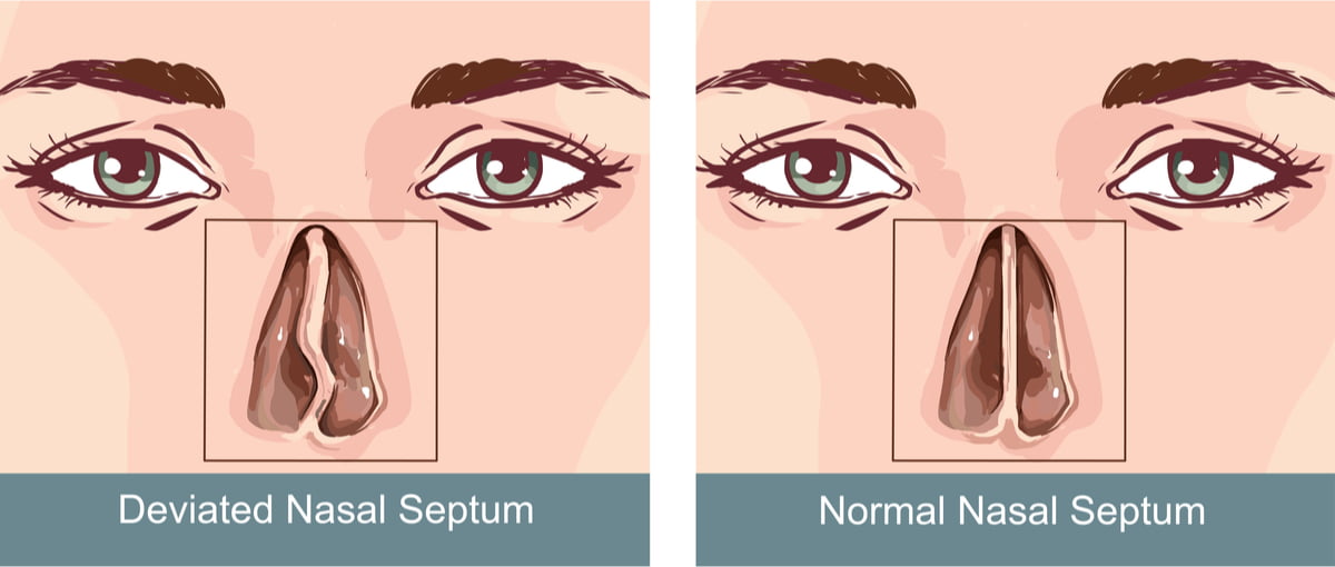 deviated and normal nasal septum