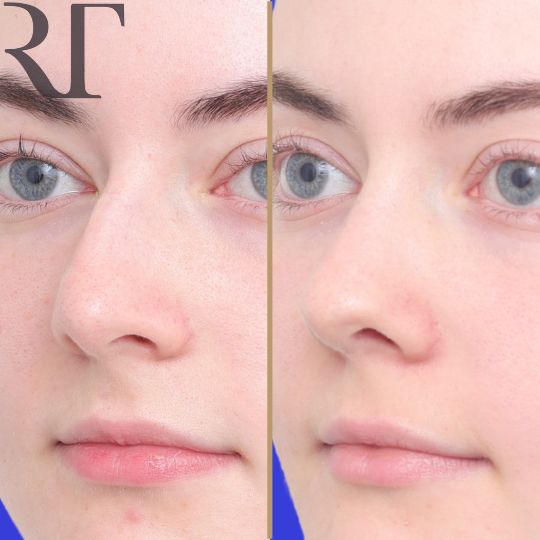 Before and after rhinoplasty photos