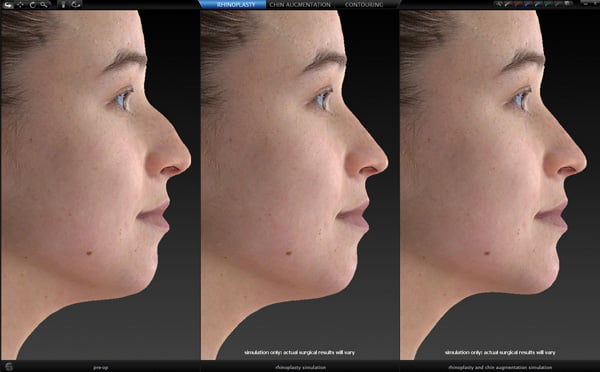 Facial Surgery - face sculptor nose & chin