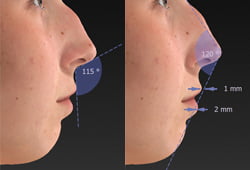 Facial Surgery Photography - Automated Measurements