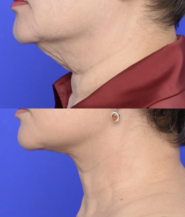 Neck Lift before and after
