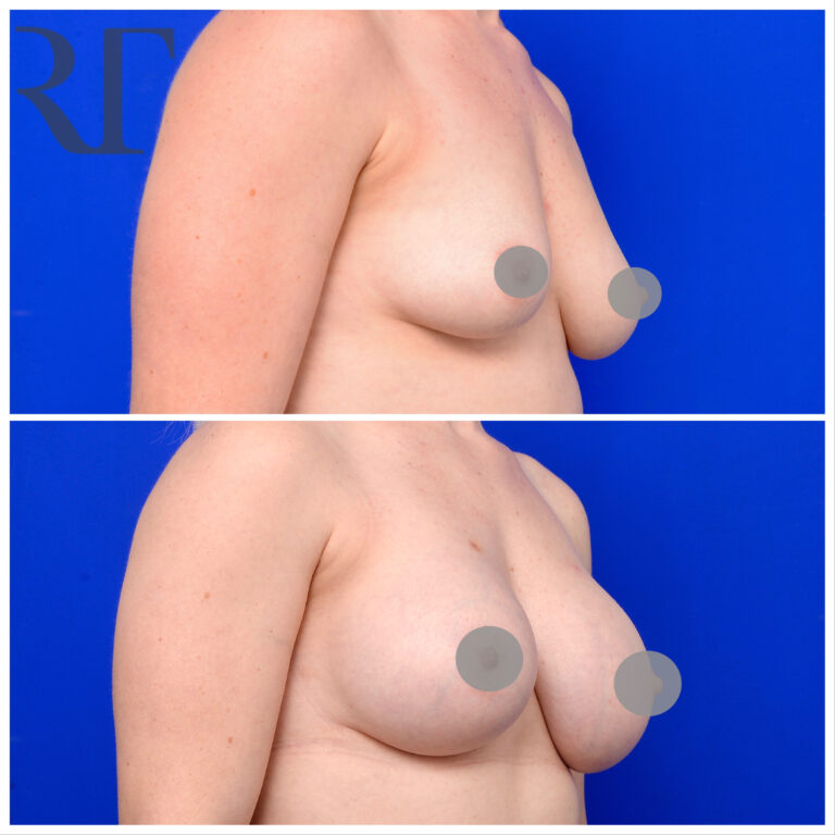 breast implant augmentation before and after photos