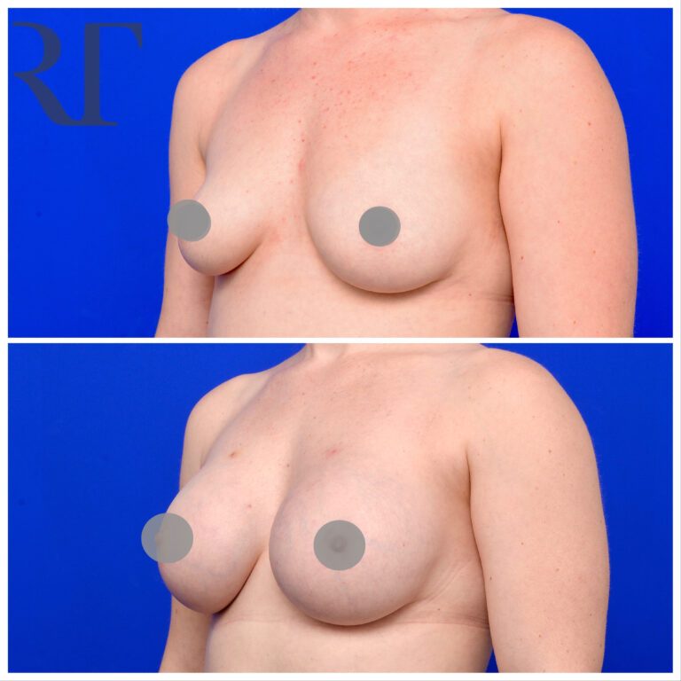 breast implant augmentation before and after photos