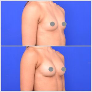 breast implant augmentation before and after photos
