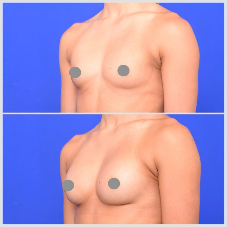 breast implant augmentation before and after photos