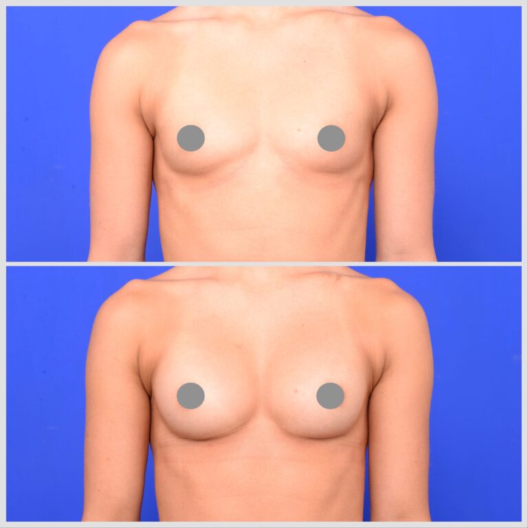 breast implant augmentation before and after photos