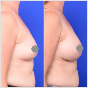 breast implant augmentation before and after photos