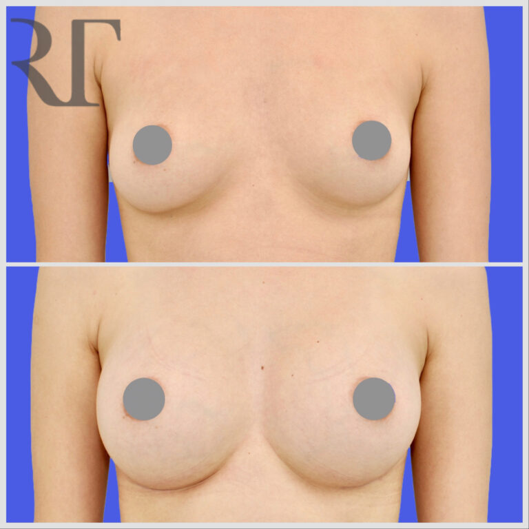 breast implant augmentation before and after photos