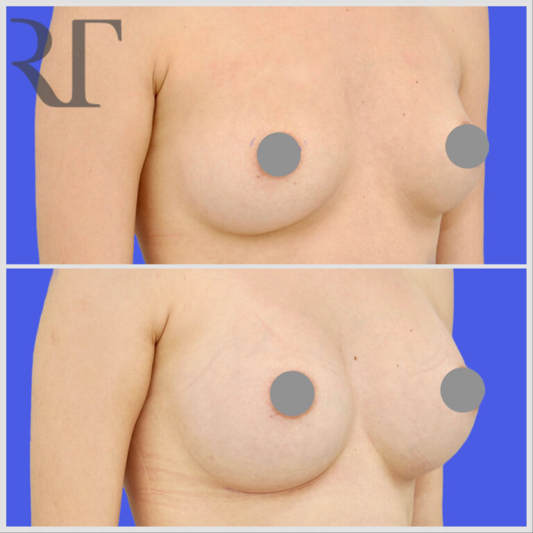 breast implant augmentation before and after photos