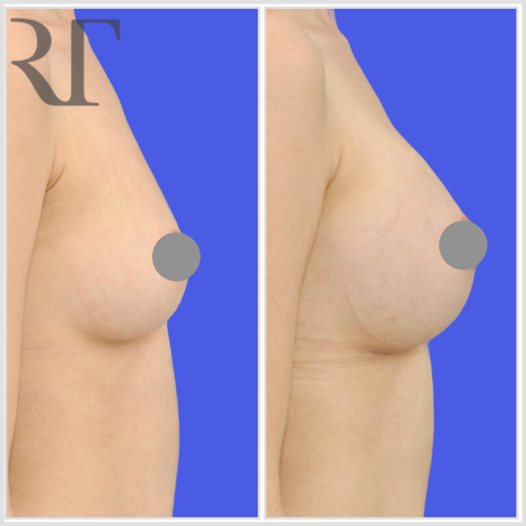 breast implant augmentation before and after photos