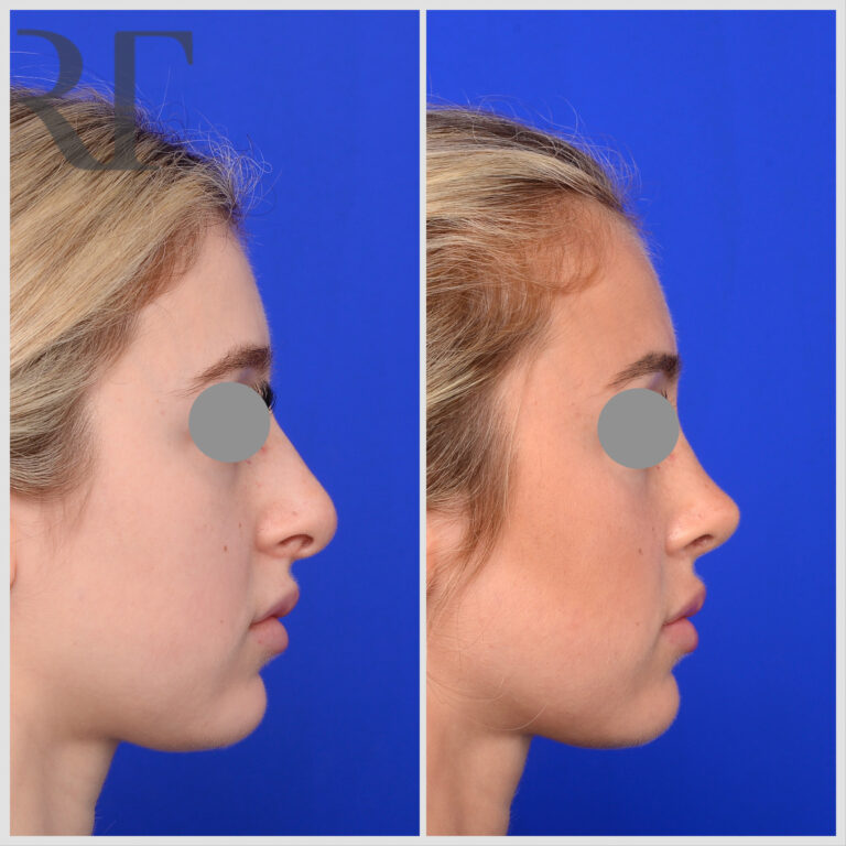 Rhinoplasty before and after, Melbourne Dr Rodrigo Teixeira
