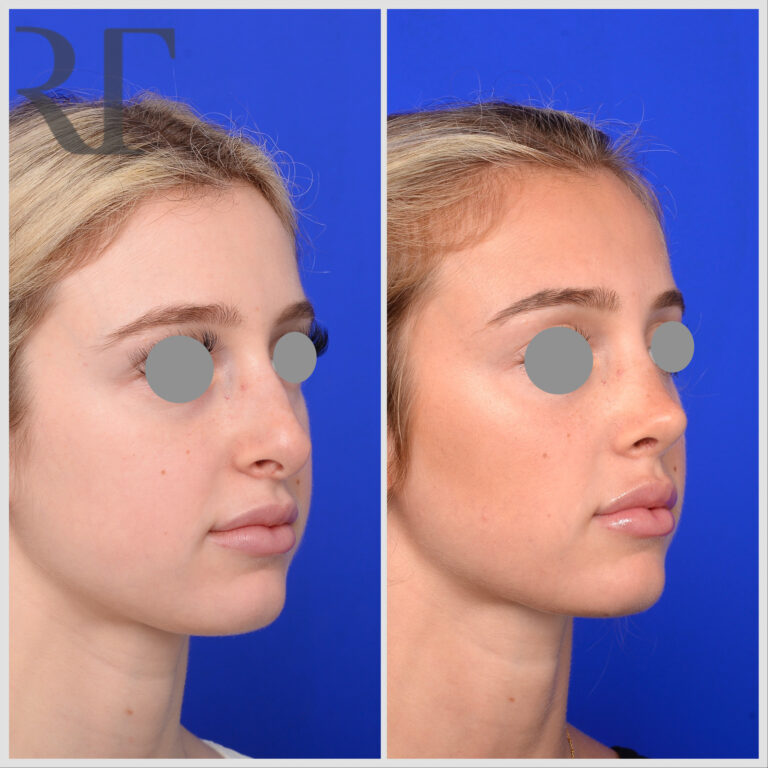 Rhinoplasty before and after, Melbourne