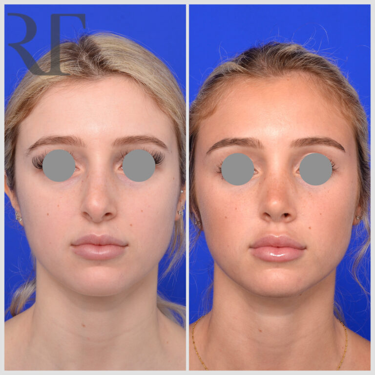 Rhinoplasty before and after, Melbourne