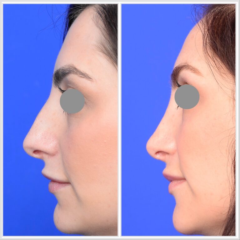 Nose job, Rhinoplasty Melpbourne
