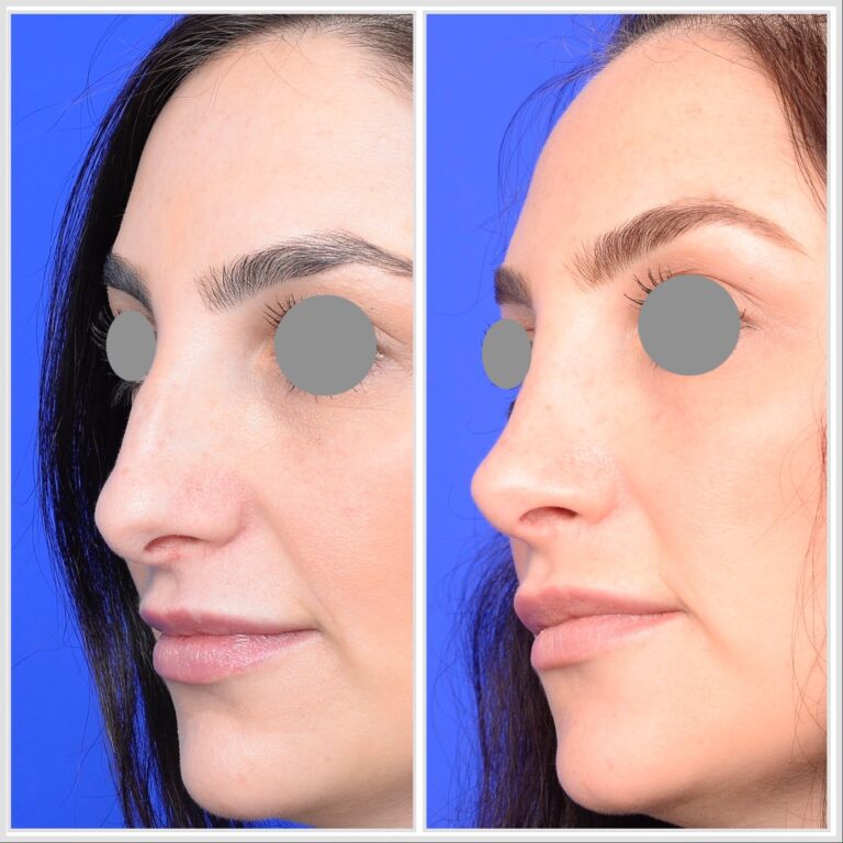 Rhinoplasty Melbourne, Dr Rodrigo Teixeira