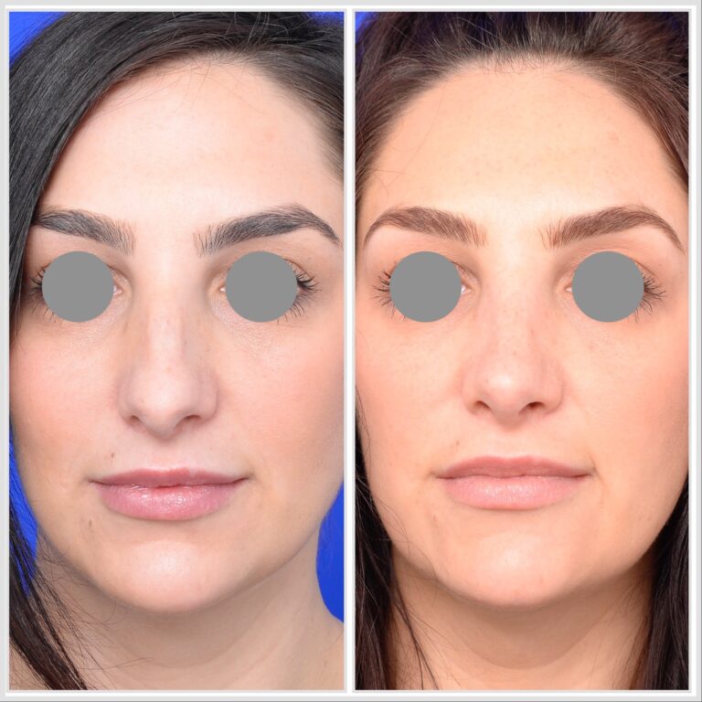 Rhinoplasty before and after, Victoria Australia