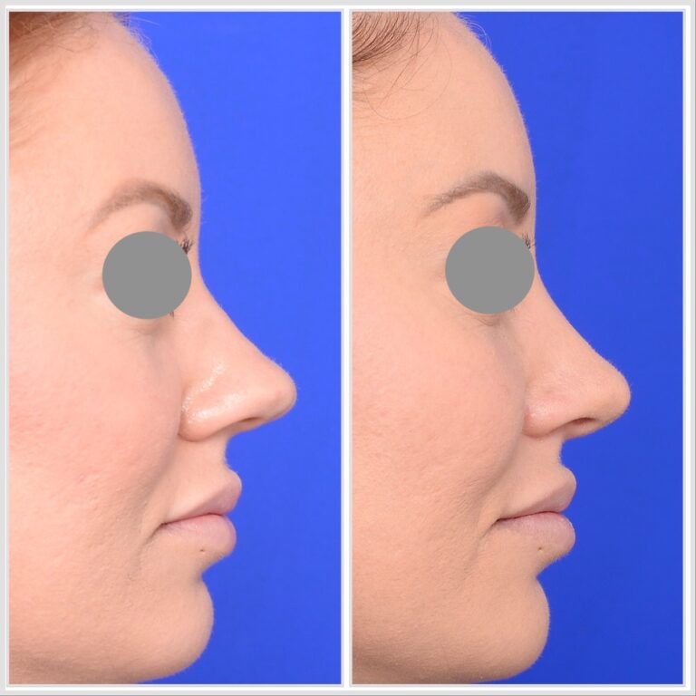 Rhinoplasty Melbourne