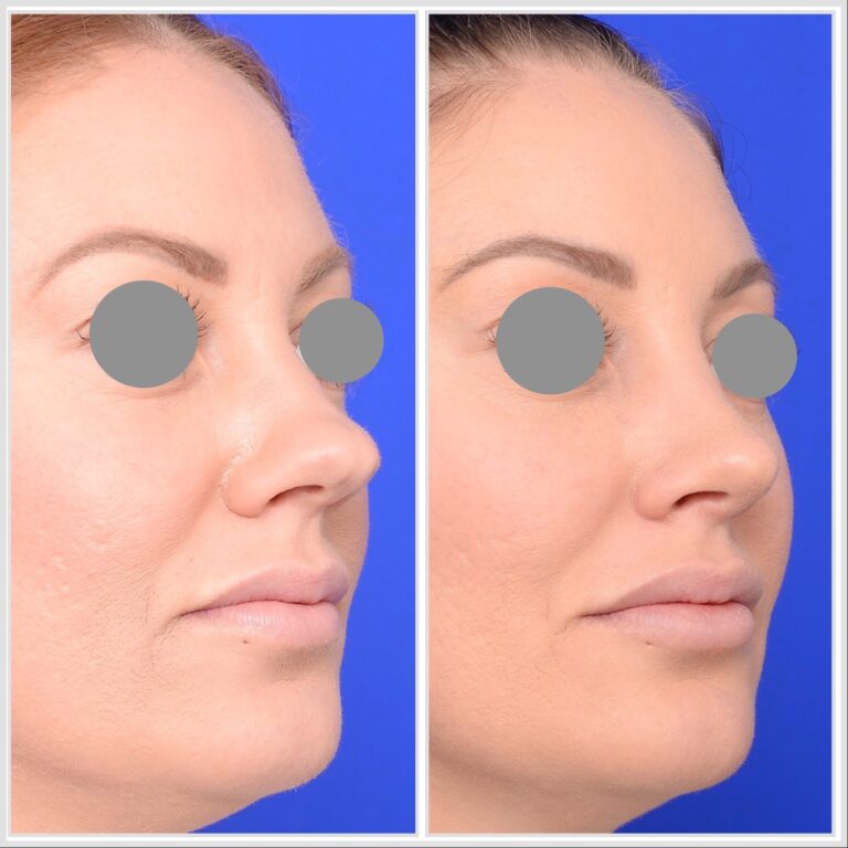 Nose Rhinoplasty Melbourne
