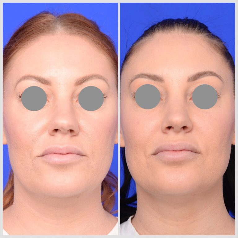Nose Job Melbourne