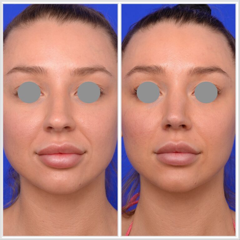 Rhinoplasty before and after, Melbourne