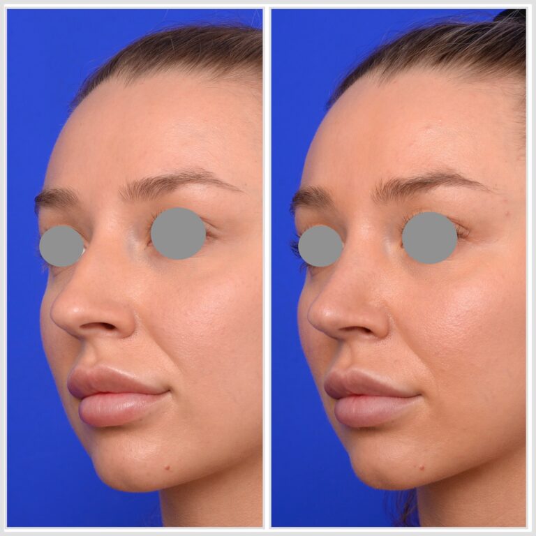 Rhinoplasty before and after, nose reshaping