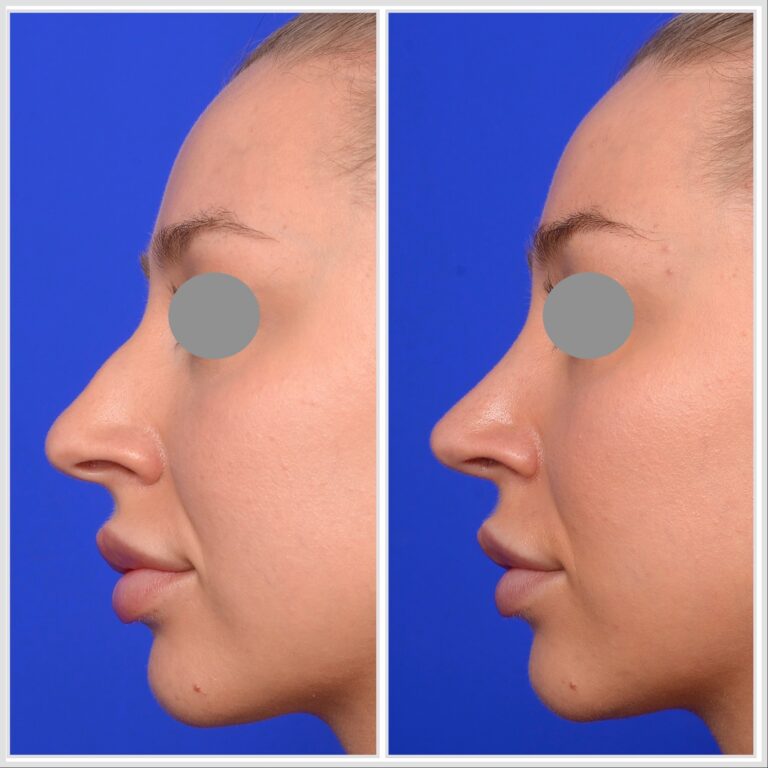 Melbourne Rhinoplasty
