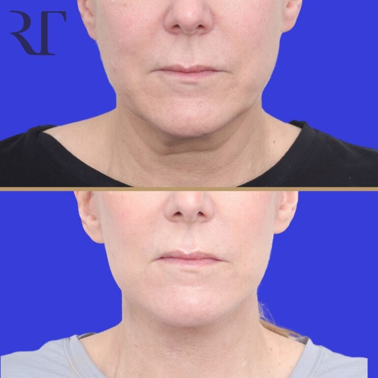 Before and after photos of Deep Plane Facelift