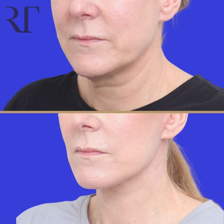 Before and after photos of Deep Plane Facelift