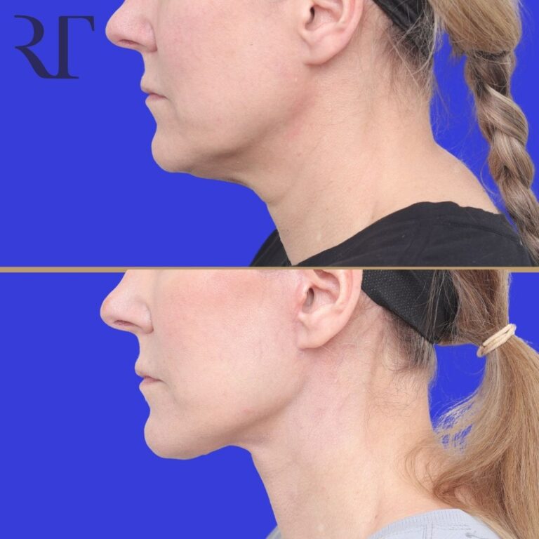 Before and after photos of Deep Plane Facelift