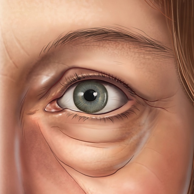 upper and lower eyelid skin excess, muscle laxity and fat pad prominence