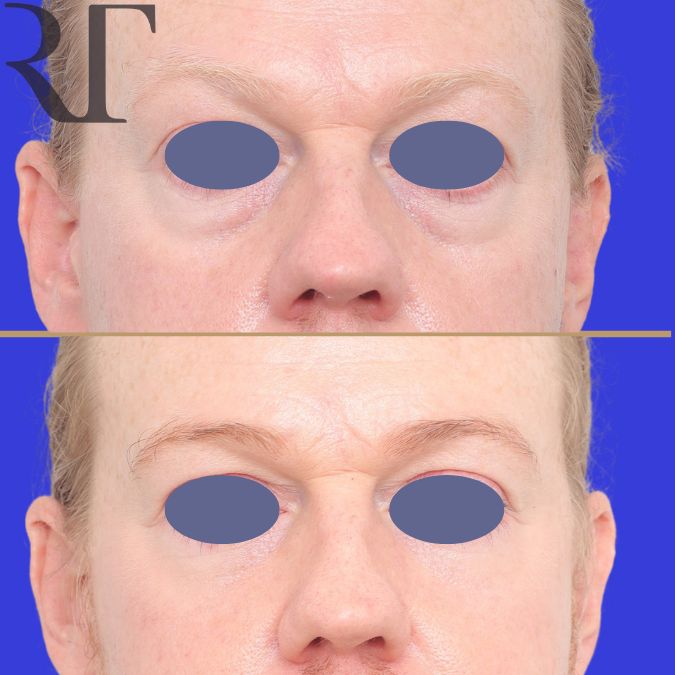 Lower bleph and fat grafting before and after