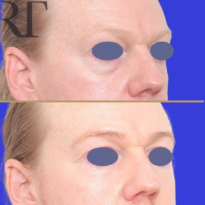 Lower bleph and fat grafting before and after