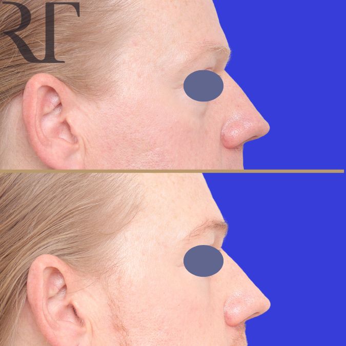 Lower bleph and fat grafting before and after