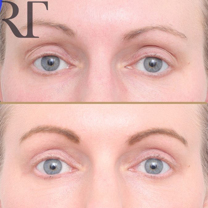 Upper Blephs before and after