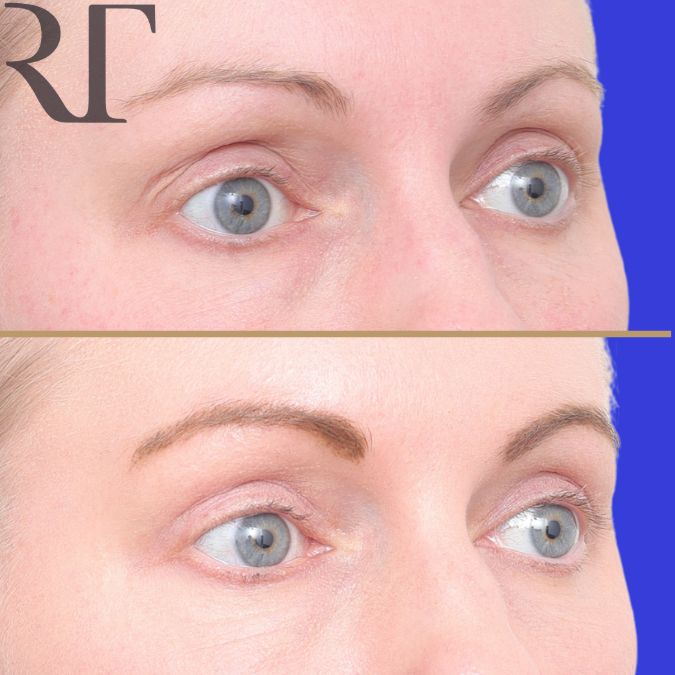 Upper Blephs before and after