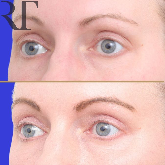 Upper Blephs before and after