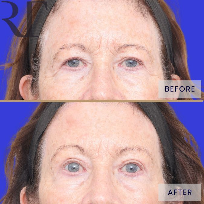 Brow and Blephs before and after