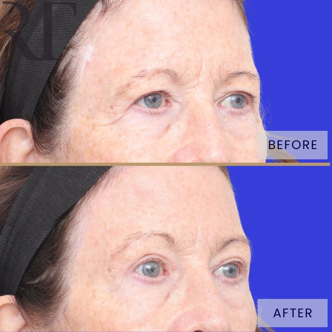 Brow and Blephs before and after