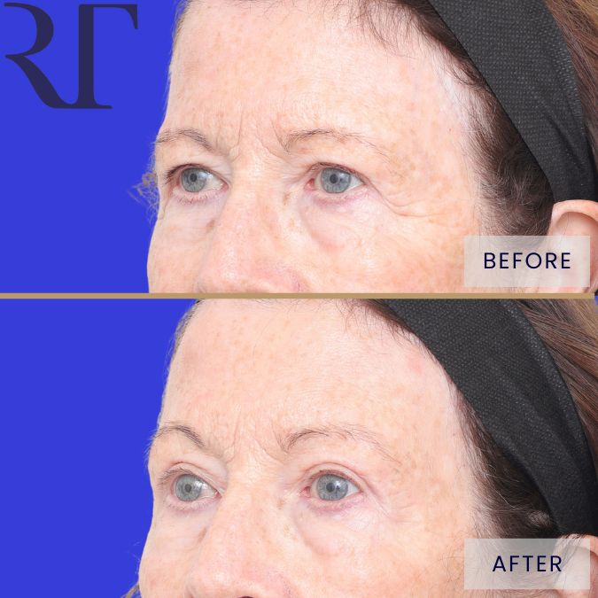 Brow and Blephs before and after