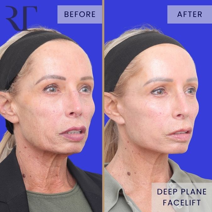 Deep Plane Facelift before and after photos