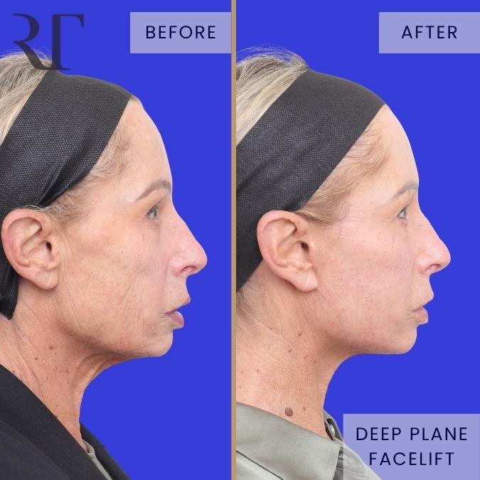 Deep Plane Facelift before and after photos