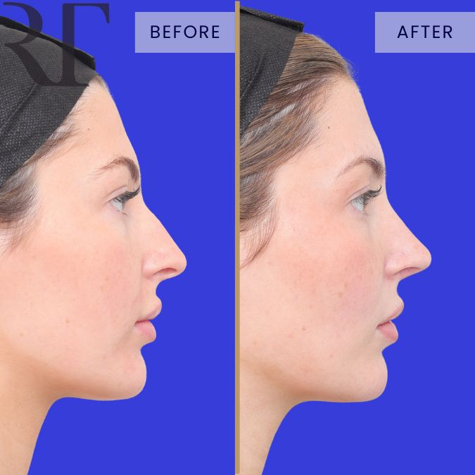 Rhinoseptoplasty before and after