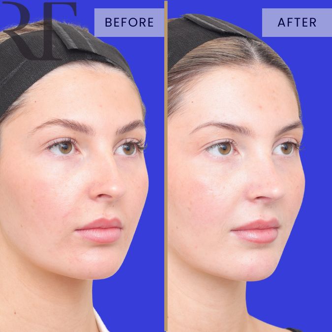 Rhinoseptoplasty before and after