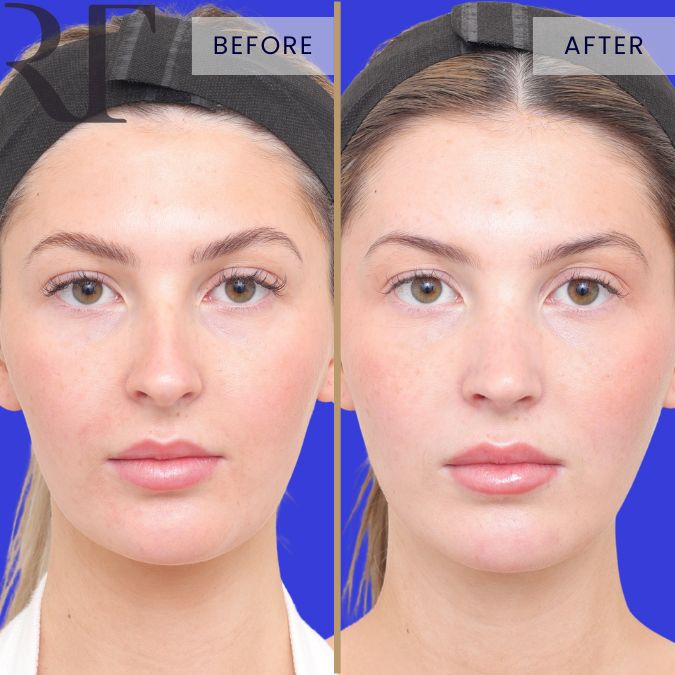 Rhinoplasty before and after, front view — straighter, narrower nasal profile six months after nose surgery