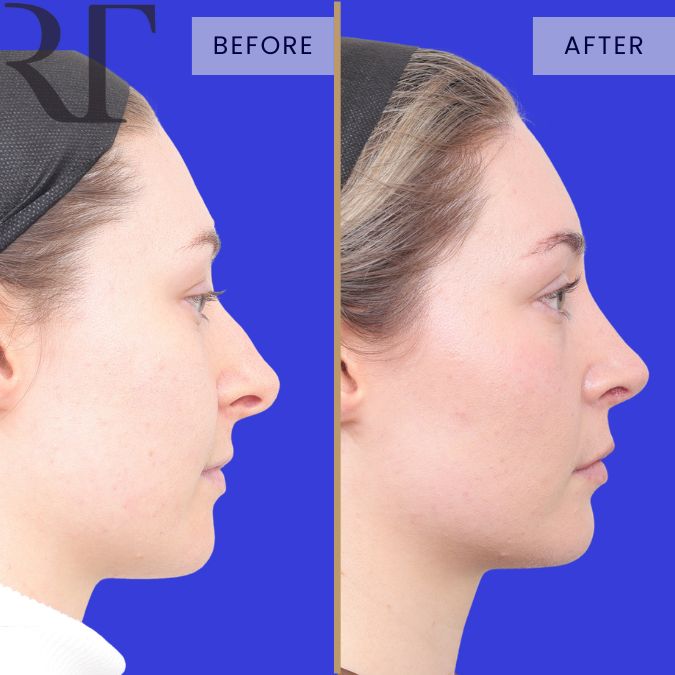 Rhinoseptoplasty before and after