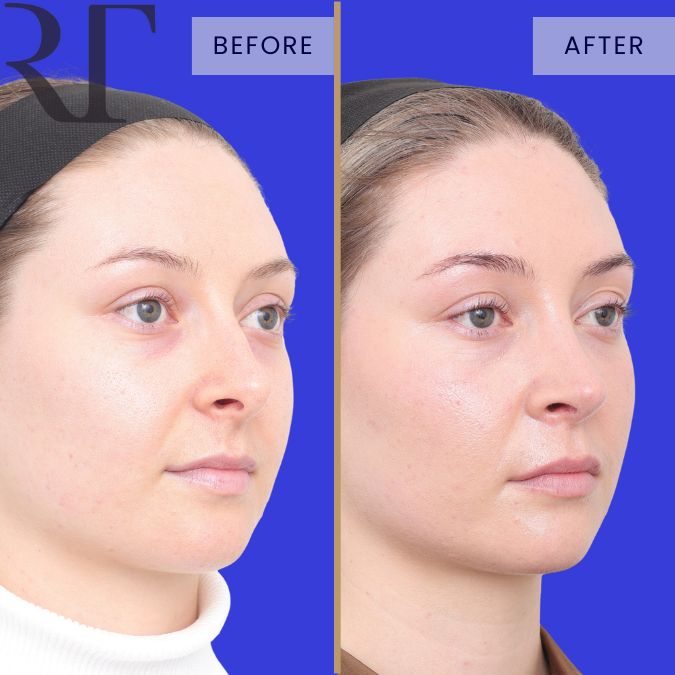 Rhinoseptoplasty before and after