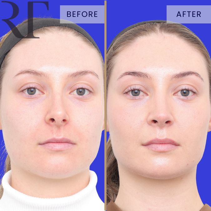 Rhinoseptoplasty before and after