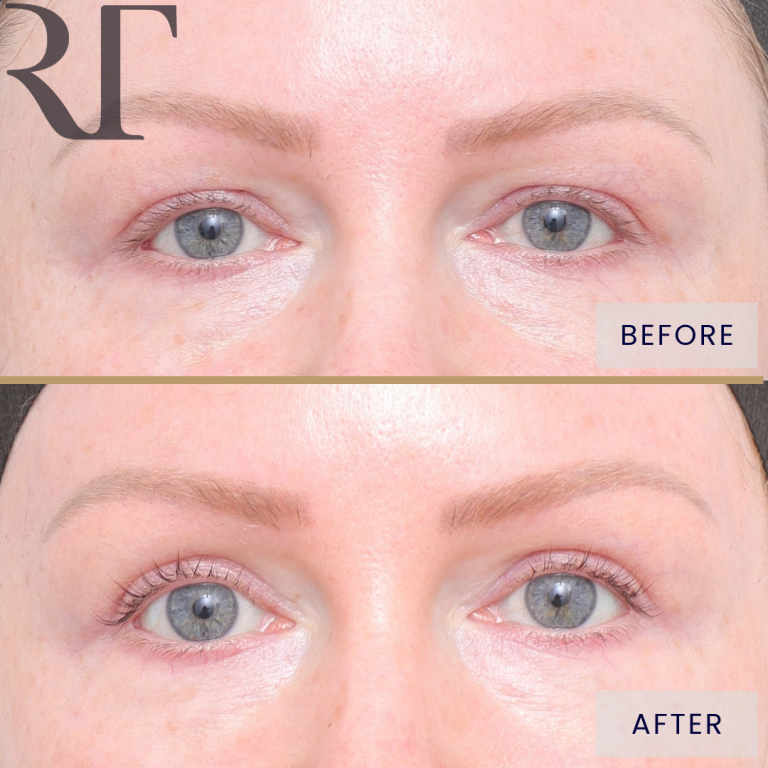 Upper blepharoplasty before and 12 months after, front view