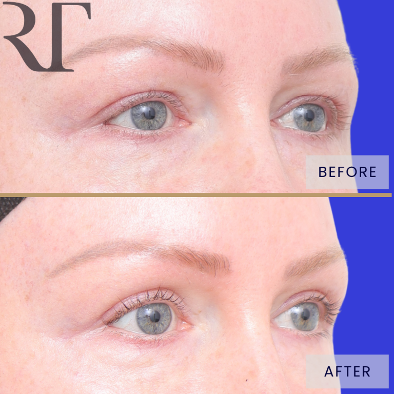Upper blepharoplasty before and 12 months after, three-quarter view (right side)